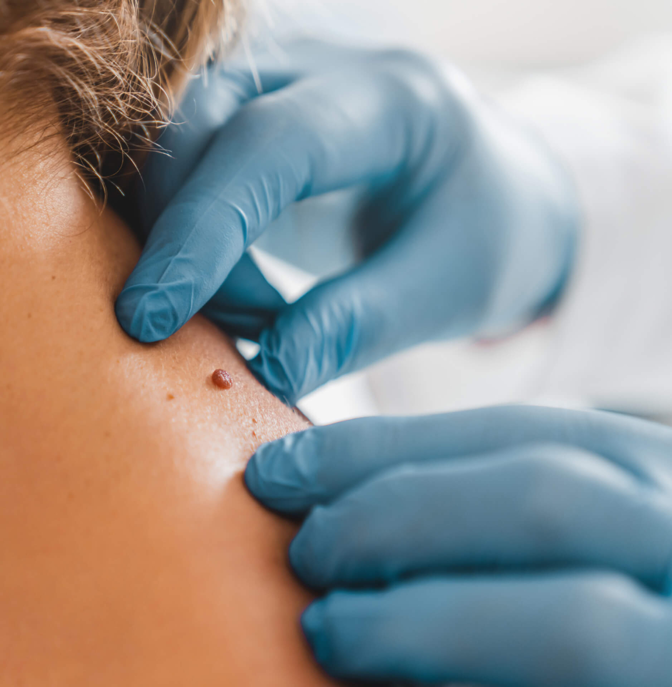 featured image - Glow Up: Warts Removal Tips for Dubai Residents