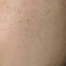 featured image - Brighten Your Skin: Pigmentation Treatment Choices in Dubai