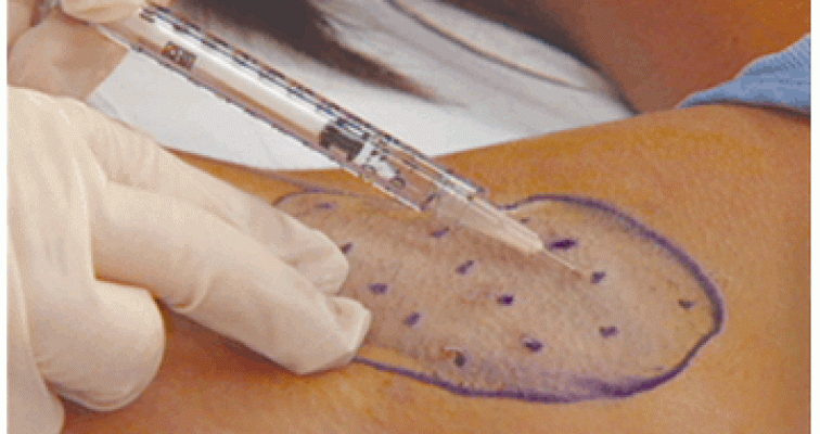 featured image - Trustworthy Hyperhidrosis Treatment in Dubai