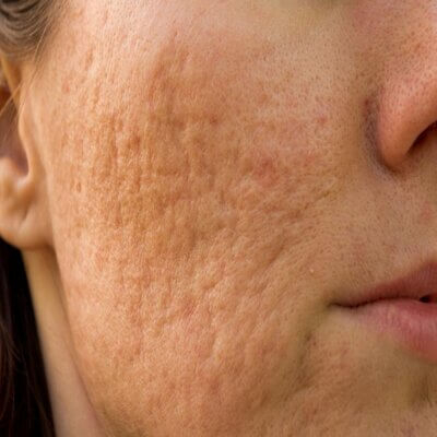 featured image - Your Solution to Acne Scars: Treatments in Dubai