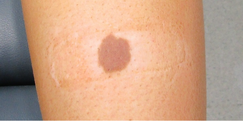 featured image - Radiate Confidence: Birthmark Removal in Dubai