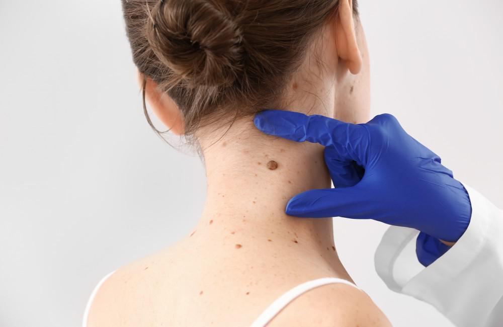 featured image - Skin Tag Removal Options: Dubai's Leading Clinics