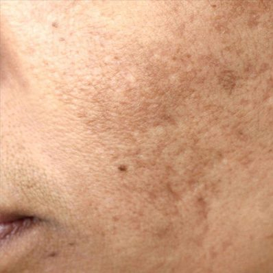 featured image - Say Hello to Clear Skin: Pigmentation Treatment in Dubai