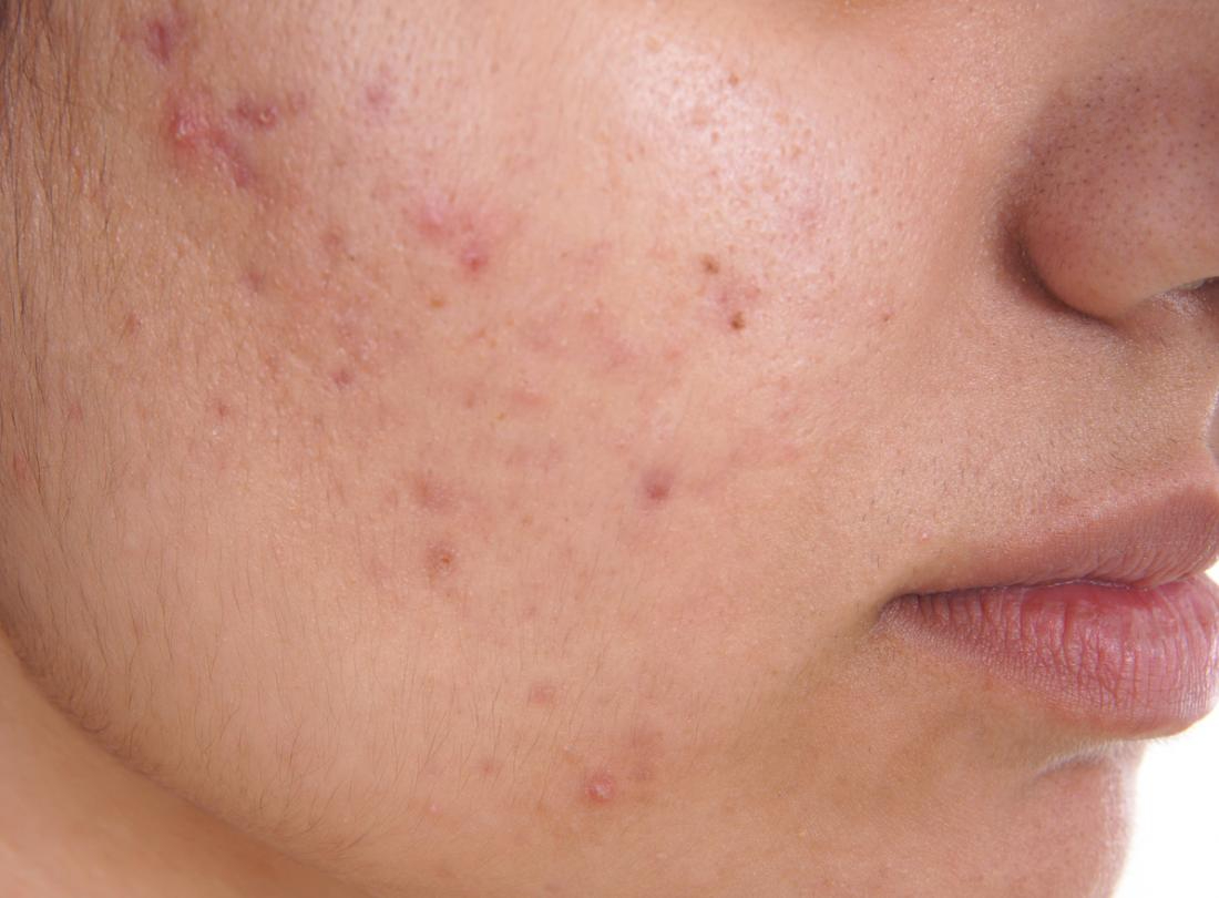 featured image - Transform Your Skin: Acne Treatment Solutions in Dubai