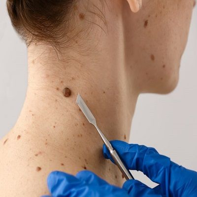 featured image - Wart Removal Expertise: Dubai's Leading Dermatologists Revealed