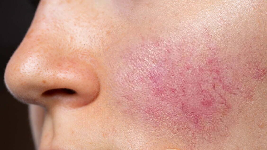 featured image - Tailored Rosacea Treatment Plans in Dubai