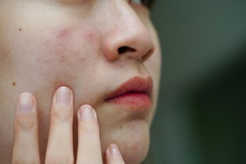 featured image - Smooth Skin, Bright Future: Acne Scar Care in Dubai