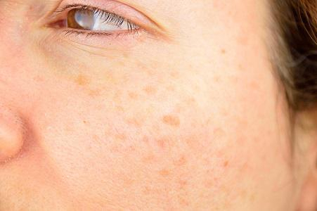 featured image - Actinic Keratosis: Dubai's Dermatology Solutions
