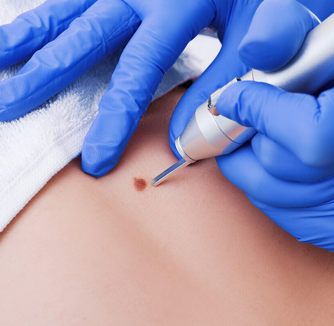 featured image - Dubai's Proven Warts Removal Treatments