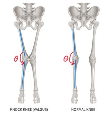 Figure 1. How “valgus angle”, θ, is defined [4].