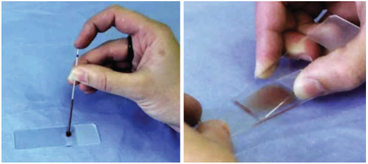Preparation of a blood smear