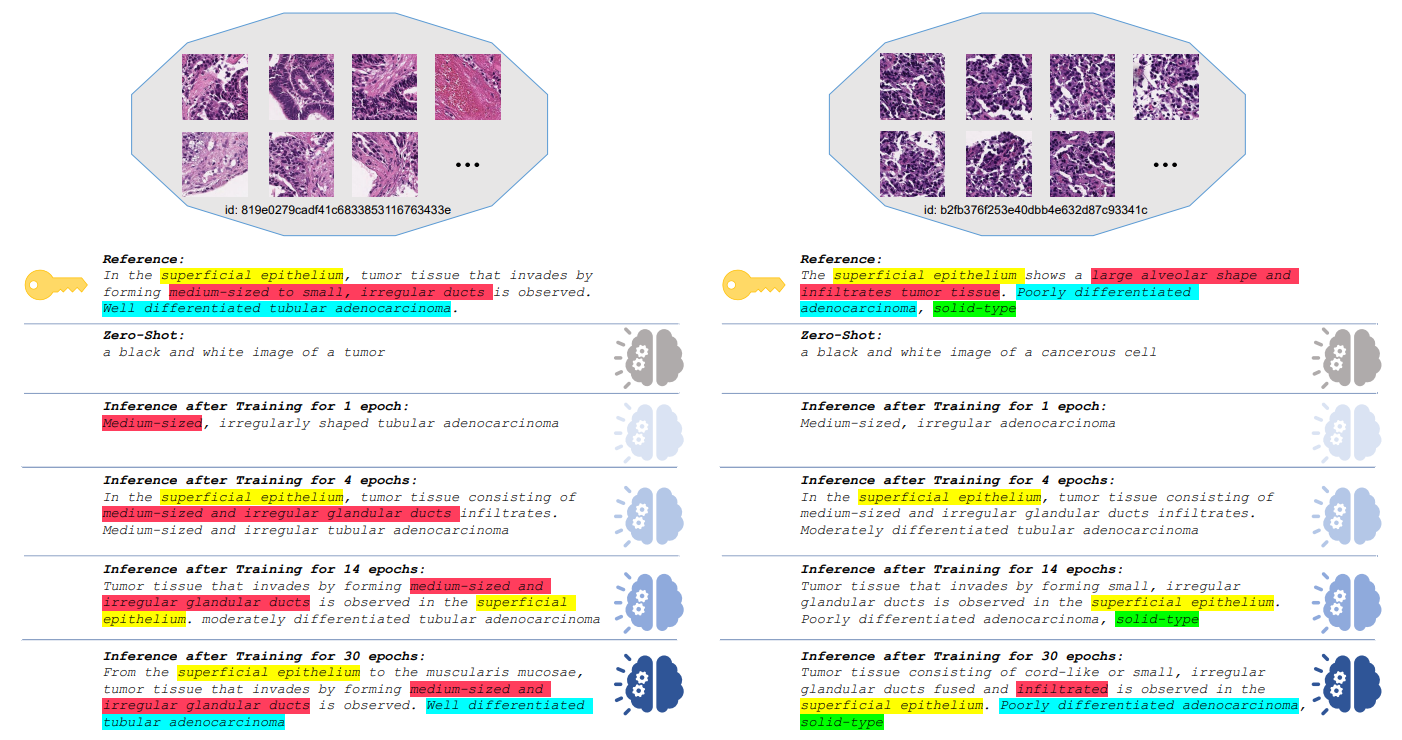 Figure 5. Visualization of Inference Results on PatchGastricADC22. We highlight details that should be focused on the reference. Zero-shot inference is performed using the pretrained BLIP2[22]. As the number of epochs increases, the model acquires more domain knowledge.