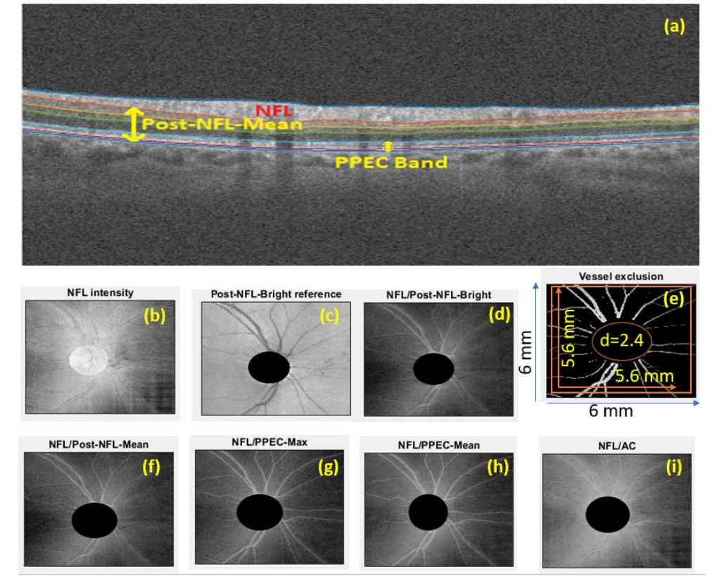 Figure 1. Illustration of reference and nerve fiber layer (NFL) reflectance map (A) NFL is defined as the band between ILM and post NFL boundary; Post-NFL is defined the bands between post-NFL boundary and BM; PPED is defined as the bands between EZ and BM. (B) NFL intensity is the summation of NFL reflectivity in the NFL band. (C) A reference is the summation of the reflectivity in the reference bands. Here the example is form post-NFL-Bright reference band, which is defined as the bright bands in the post-NFL bands, or the top half if we sort the OCT pixels in the post-NFL bands based on intensity. (D) NFL reflectance normalized by reference post-NFL-Bright. (E) Disc and larger vessel was detected. The overall average of NFL reflectance is only on the mask without disc and vessels. (F)-(I) NFL reflectance normalized by other reference: Post-NFL-Mean, PPEC-Max, PPEC-Mean and attenuation coefficient (AC). 