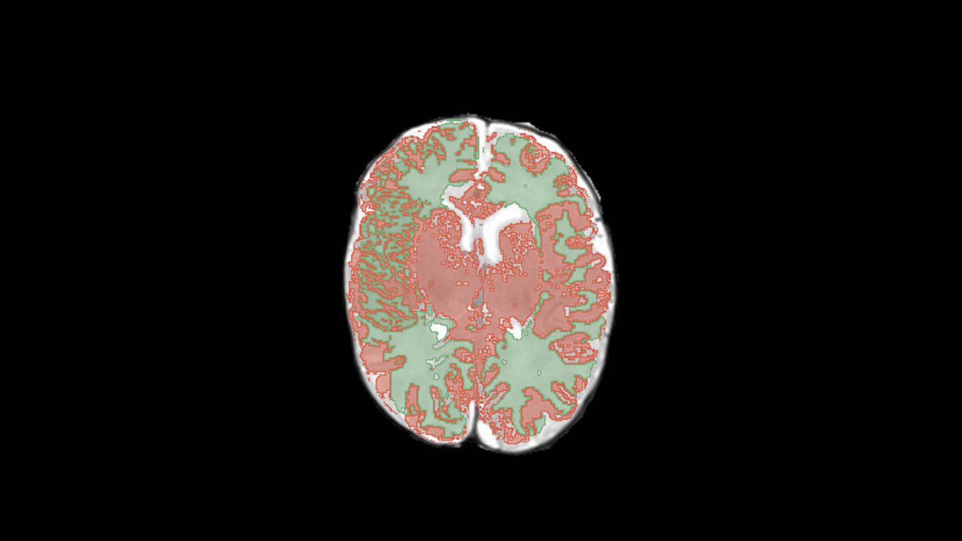 Brain MRI with annotation overlay