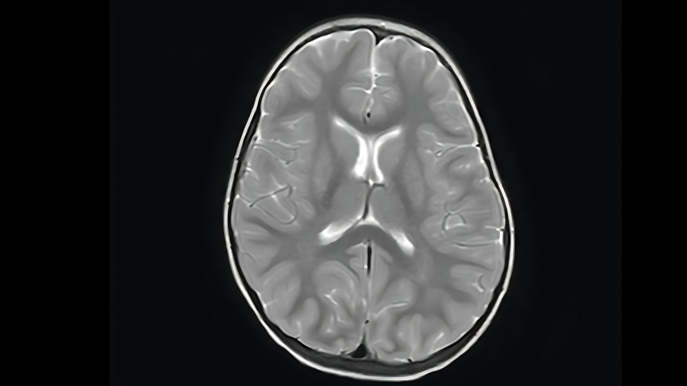 This is the type of image radiologists usually work with. Without a trained eye, the boundary between white matter and gray matter is difficult to distinguish.