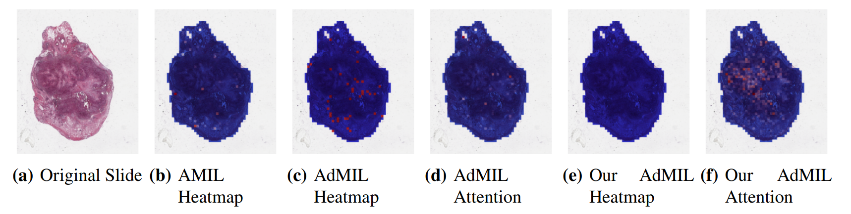 Figure 9: Heatmaps produced by the models for slide cf1ee3be-f161-4614-b2dd-030a9adfc5fc for the gene mutation detection task at 20x magnification. (a) Slide at thumbnail level; (b) AMIL attention scores; (c) AdMIL’s final patch scores; (d) AdMIL’s attention scores; (e) Our version of AdMIL’s final patch scores; (f) Our version of AdMIL’s attention scores.
