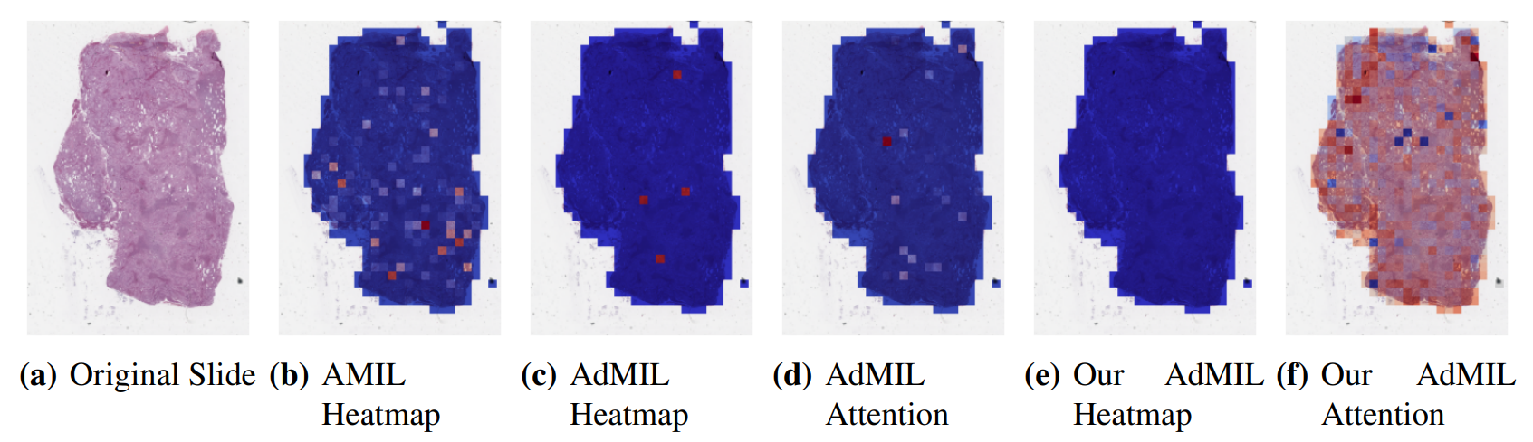 Figure 8: Heatmaps produced for slide d42eb4ce-d300-46be-8b46-059a98c2ddb8 for the gene mutation detection task at 10x magnification. (a) Slide at thumbnail level; (b) AMIL attention scores; (c) AdMIL’s final patch scores; (d) AdMIL’s attention scores; (e) Our version of AdMIL’s final patch scores; (f) Our version of AdMIL’s attention scores.