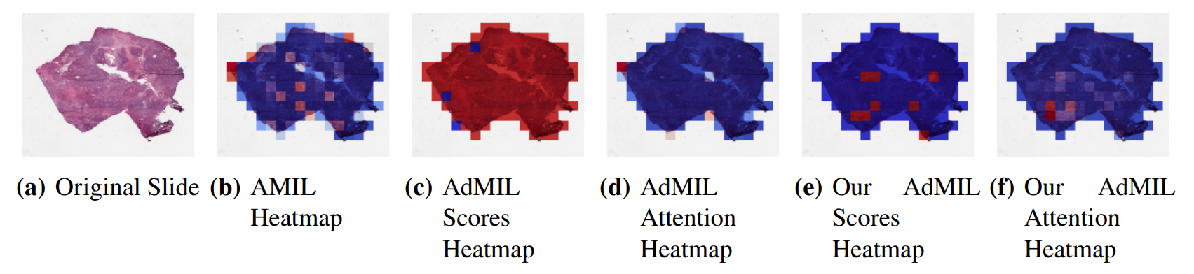 Figure 7: Heatmaps produced for slide 05194610-c32d-44db-be55-c38652d547b8 for the tumor detection task at 5x magnification. (a) Slide at thumbnail level; (b) AMIL attention scores; (c) AdMIL’s final patch scores; (d) AdMIL’s attention scores; (e) Our version of AdMIL’s final patch scores; (f) Our version of AdMIL’s attention scores.